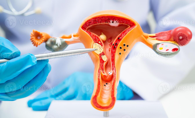 Cervical Cancer in the Greater Accra and Ashanti Regions of Ghana